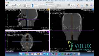 Volux  Tutorial OsiriX Lite parte 2 di 2 [upl. by Crean784]