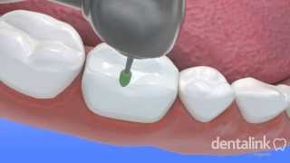 INCRUSTACIÓN dental  Video 3D paso a paso [upl. by Thaddus]