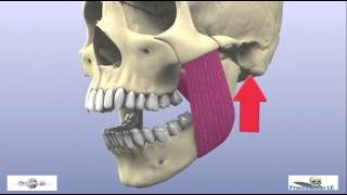 fracture of the mandibular condyle part 2 [upl. by De Witt227]