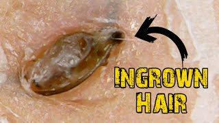 Ingrown Hair Removal x Satisfying Blackheads [upl. by Rhine]