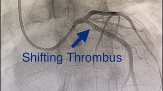 Thrombus Shifts to LCX Acute Anterior MI Cardiogenic Shock Ostial LAD Occlusion How To Treat [upl. by Wit]