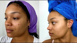 CHEMICAL PEEL AT HOME BEFORE amp AFTER EBANEL SKINCARE [upl. by Golden]