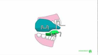 Apparecchi Funzionali Mobili ATTIVATORE  TWIN BLOCK [upl. by Ahseuqal]