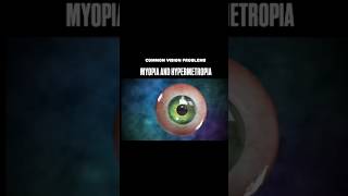 Myopia and Hypermetropia biology neet education [upl. by Beesley]