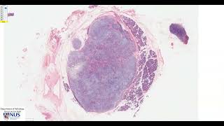 Salivary gland Pleomorphic adenoma Microscopy  Talking slide [upl. by Mell]