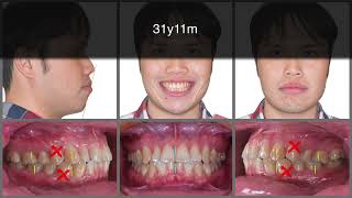 First Premolar Extraction Treatment with Clear Aligners｜【Chris Chang Ortho】CC568 [upl. by Harper]