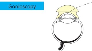 Gonioscopy explained fully [upl. by Gosney]