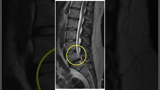 Lumbar Disc Extrusion recovery at home sciatica discextrusion backpain sciaticapainrelief l4l5 [upl. by Greenebaum]