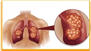 Wczesne objawy raka płuc – 9 najczęstszych objawów [upl. by Selrhc]