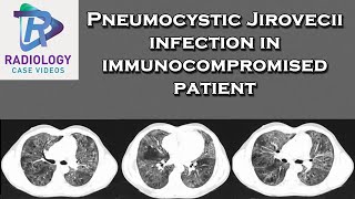 Pneumocystic Jirovecii infection in immunocompromised patient [upl. by Amsab196]