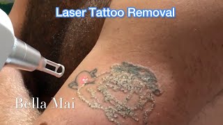 Laser Tattoo Removal  Before After 1st 2nd amp 3rd sessions [upl. by Ainecey]