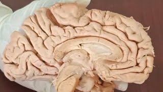 Anatomy of the human Brain  brain corpus callosum [upl. by Youngman]