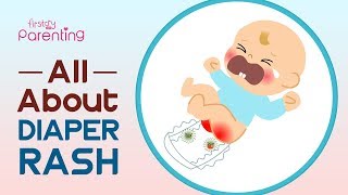 Diaper Rash in Babies – Symptoms Causes and Remedies [upl. by Yttocs581]