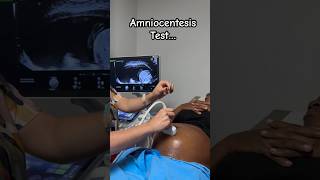 Amniocentesis Test Processes … Amniotic fluid from abdomen to rule out congenital defect [upl. by Khanna667]