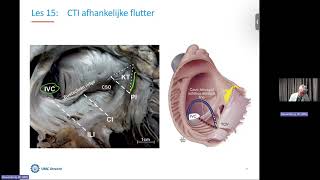 Online EP Les 15 RA isthmus afhankelijke flutter [upl. by Havener]