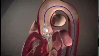 Edwards SAPIEN Transcatheter Heart Valve with the RetroFlex 3 Transfermoral System TAVR [upl. by Mia]