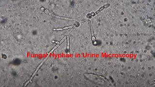 Fungal Hyphae in Urine Microscopy [upl. by Iliak]