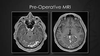 Staged transarterial endovascular embolization of malignant dAVF using Onyx amp nbutyl cyanoacrylate [upl. by Aggie]