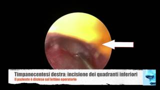 Otite media cronica glue ear aspirazione di secrezioni dalla cassa del timpano [upl. by Tadeo]