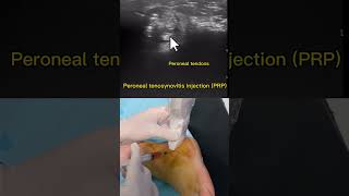 Peroneal tendon injection PRP [upl. by Sherye]