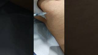 hidrolipoclasia não aspirativa para gordura localizada hidrolipo ultrassonica destrói gordura [upl. by Reg]