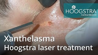 Xanthelasma  Hoogstra laser treatment 22082 [upl. by Nyliahs]