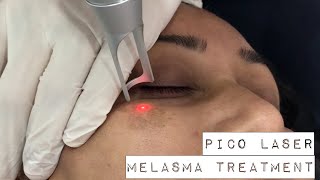 Melasma treatment with PICO Laser [upl. by Irma]