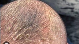 How to get rid of cradle cap in babieswhat is cradle cap [upl. by Allx764]