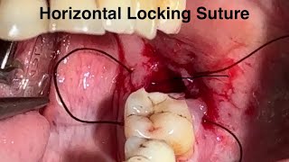 Horizontal locking suture post extraction l 7044611705 l DrArindam Mandaloralsurgery [upl. by Raseta]