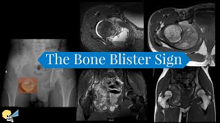 The Bone Blister Sign [upl. by Weisler]