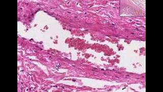 Histopathology Lung pleura Adhesion [upl. by Nonnaehr397]