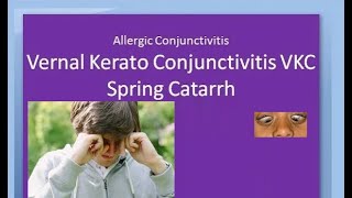 Ophthalmology 088 a Vernal KeratoConjunctivitis VKC Spring Catarrh Allergic Horner Tranta Eye [upl. by Lledualc]