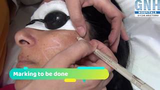 Treatment of Melasma amp Hyperpigmentation at GNH Hospital Gurgaon [upl. by Eirised283]