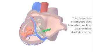 Mitral Stenosis  sound amp animation [upl. by Airetahs]