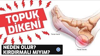 Topuk Dikeninin Kırdırılması Çözüm mü Neye Dikkat Etmeli Topuk Dikeni [upl. by Carlen]