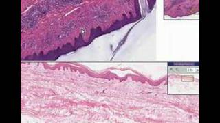 Histopathology SkinLymphocytic infiltrate possible tick b [upl. by Aramot]