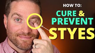 How To CURE And PREVENT STYES Get Rid Of A Hordeolum stye And Chalazion Fast [upl. by Hyacinthia]