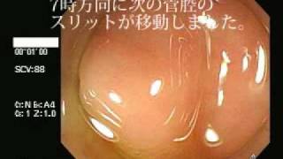 大腸内視鏡検査 TypeC Colonoscopy [upl. by Hartzke]