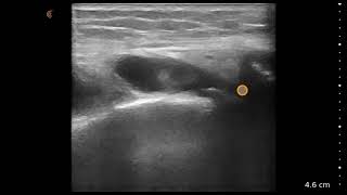 Lateral Meniscus and Knee Effusion  Ultrasound Image Interpretation [upl. by Nosyk382]