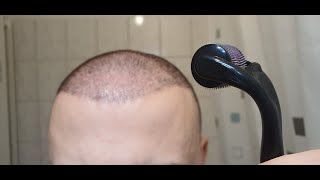 Minoxidil amp Dermarolling Results 6 MONTHS  Month by Month Progress [upl. by Ylla]