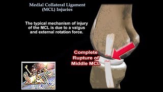 Medial Collateral Ligament Injuries  Everything You Need To Know  Dr Nabil Ebraheim [upl. by Ebsen]