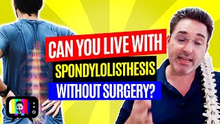 11Can you live with spondylolisthesis without surgery [upl. by Nizam]