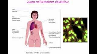 umh1947 201213 Lec001 Otras enfermedades de base autoinmune I [upl. by Okramed966]