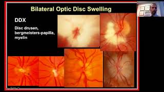 Approach to the Patient with Bilateral Optic Disc Swelling [upl. by Toth]