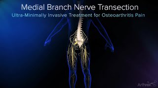 Endoscopic Medial Branch Nerve Transection [upl. by Alcus]