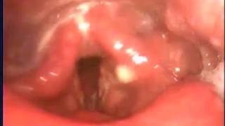 急性咽喉炎與膿痰 聲帶水腫 劉耿僚 acute laryngopharyngitis amp laryngeal edema [upl. by Yrram]