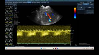 IQ 304 IVER DOPPLER ULTRASOUND ECHOPAC ANALYSIS 1 [upl. by Adnolohs]