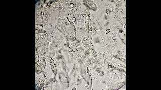 فحص الادرار العام urinalysis urineexamination GUE epithelial cells pus cells Bacteria [upl. by Einnahpets]