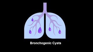 Bronchogenic Cysts Symptoms and Causes  Diagnosis  Treatment  Prevention disease healthcare [upl. by Anawk]