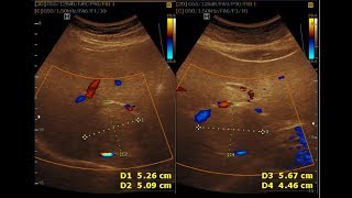 Ultrasound cases 494 of 2000  Hemangioma Grade 1 Fatty Liver [upl. by Hanavas381]